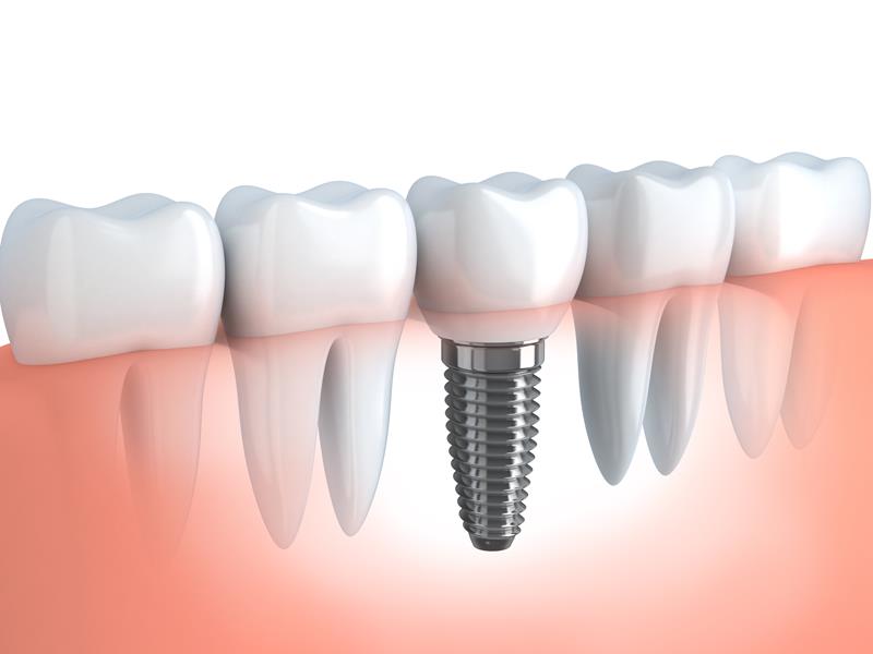 Dental Implants  Vienna, VA 