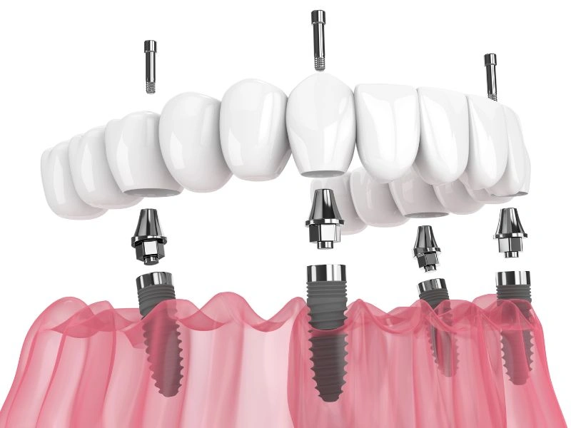 are all on 4 dental implants worth it