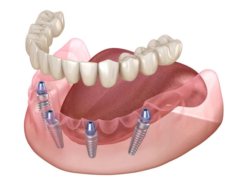 consider all on 4 dental implants