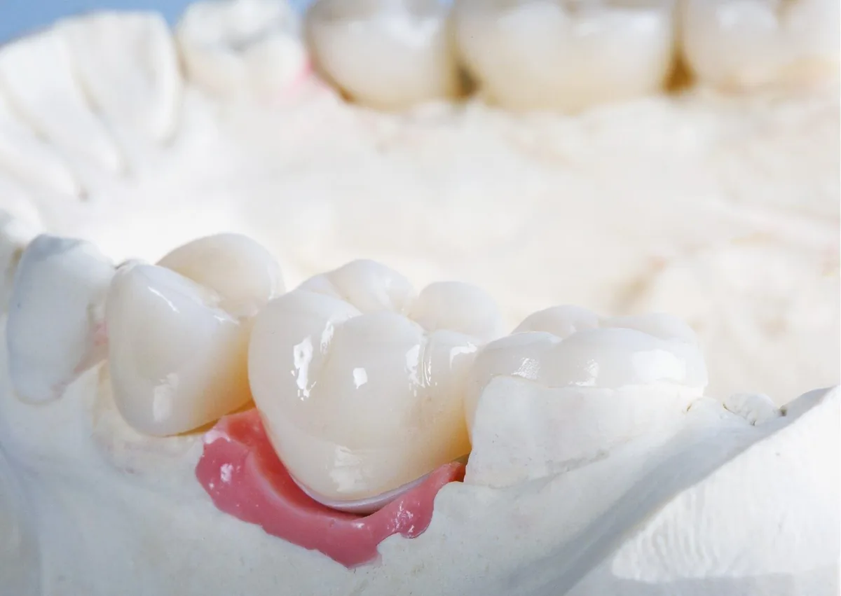 Close-up of dental crowns on a tooth model showing how crowns restore damaged teeth.